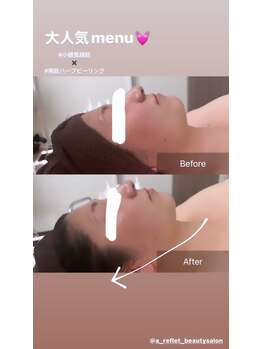 ア ルフレ(A.reflet)/小顔整顔筋