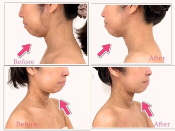 アファン 鶴見店(Afun)/小顔BeforeAfter