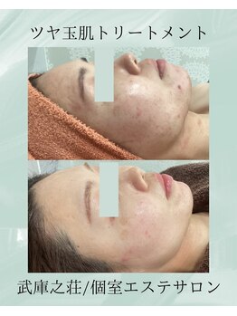 エデン(Eden)/艶肌トリートメント