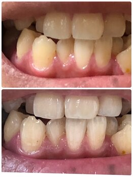 アン リオン(UN LiON)/セルフホワイトニング