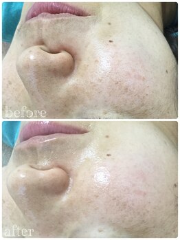 メイユール(MEILLEUR)/光フェイシャル1回