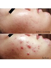 メゾリーナ(MAISOReNA)/水光ピーリング