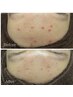 【繰り返すニキビケア改善】肌トラブルに合わせた肌質改善ピーリング＋ヘッド