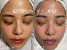 ネオリー(neorii)/毛穴洗浄×ハーブピーリング