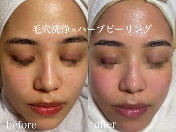 ネオリー(neorii)/毛穴洗浄×ハーブピーリング