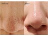 毛穴の開き/ザラつきが気になる方へ!肌診断付き小鼻アクアピュア毛穴洗浄★