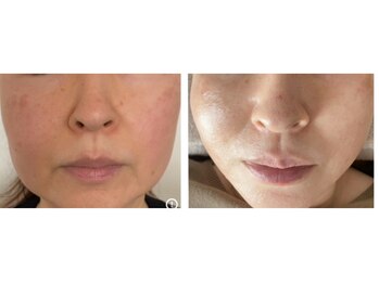 エステティックセラピー プレマ(PREMA)/月一施術でこんなにリフトアップ