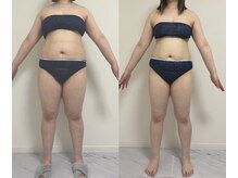 プリマルーチェ/脂肪冷却