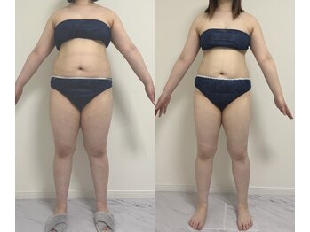 プリマルーチェ/脂肪冷却