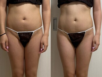 痩身・美肌管理専門店　private salon pixie【ピクシー】/大人気のハイパーナイフ！