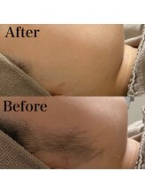 ミーエイト(Mii∞)/《もみあげBefore/After》