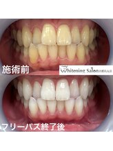 ホワイトニングサロン 京都烏丸店/ホワイトニング施術例