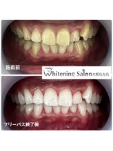 ホワイトニングサロン 京都烏丸店/ホワイトニング施術例