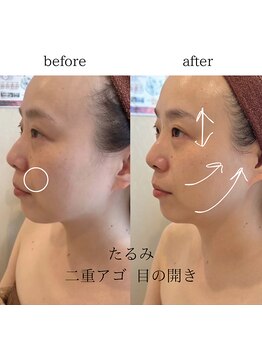 ビオスパ(BioSpa)/WINBACK☆ビフォーアフター