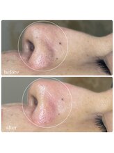 ちらちゅら/ハイドロ毛穴洗浄