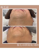 コリラ(CORILA)/メンズ◆ヒゲ脱毛