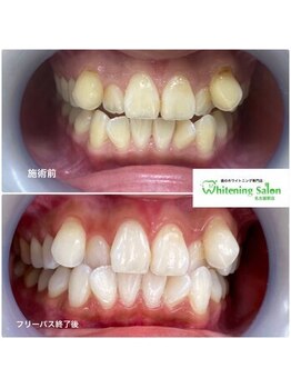 ホワイトニングサロン 名古屋駅店/【ホワイトニング施術例】