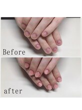 ティアラネイル 宇都宮/深爪矯正