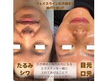 ワッカ(wacca)の雰囲気（何をしても変わらなかった方。幹細胞エクソソームで素肌力UP！）