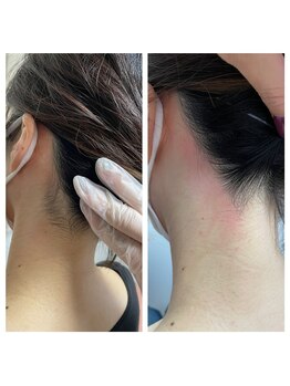 コフー(co-fuu)/脱毛施術