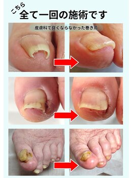 全て一回の施術です