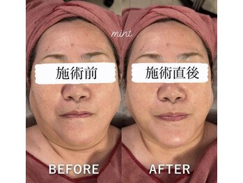 ミント(Mint)/脂肪分解液導入でスピード小顔!