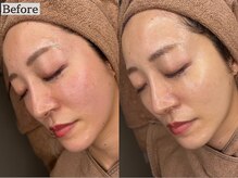 あすはれ/月1メンテにおすすめララピール