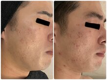 レア(Lea)/頑固なニキビケア〇3回で変わる