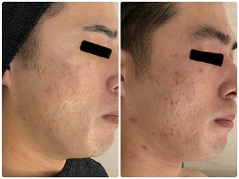 レア(Lea)/頑固なニキビケア〇3回で変わる