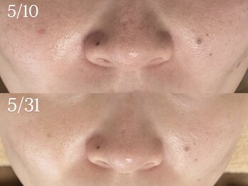 ビューティーサロン プティ(beauty salon petite)/ハーブピーリング/毛穴/黒ずみ