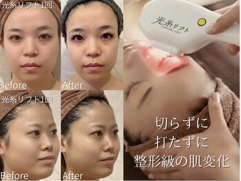 リリィ/人気No.1 光糸リフト！