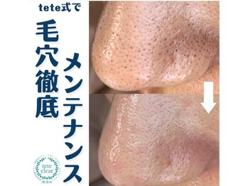 ヒメミ(Himemi)の写真/《話題☆毛穴エクストラクション導入!!》これまでのケア/お手入れで解決できなかった方必見☆美肌をGET◎