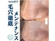 ヒメミ(Himemi)の写真/《話題☆毛穴エクストラクション導入!!》これまでのケア/お手入れで解決できなかった方必見☆美肌をGET◎