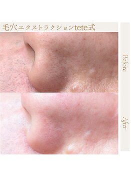 サロン サルタス(salon Saltus)/毛穴