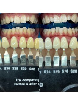 トウキョースワーズ 渋谷店(TOKYO SWRS)/#ホワイトニング #渋谷 #池袋