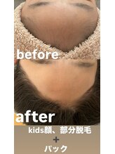 エムエー(MA)/部分脱毛