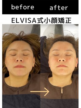 エレヴィザ トウキョウ 恵比寿院(ELVISA TOKYO)/ELVISA式小顔矯正 初回施術