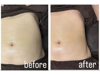 エトワール(etoile)/RED SHOT×キャビテーション