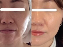 ジョーヌ(JAUNE)/肌質・ほうれい線まとめて激変