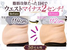 イワサキ(IWASAKI)の雰囲気（地域初の脂肪冷却機器を導入。気になる部分を冷やして寝るだけ◎）