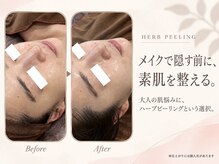 ウィンク 勝どき(wink)の雰囲気（話題沸騰中★ハーブピーリング！剥離なしで翌日からメイクOK！）