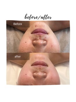 ビューティリュクス(beauty luxe)/リベルハーブピーリング