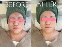 ナンバー18(N゜18)/幹細胞入り♪ハーブピーリング