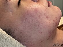 サロン ド エメ(salon de aimer)/【Before】赤み、ニキビケアに！