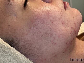 サロン ド エメ(salon de aimer)/【Before】赤み、ニキビケアに!