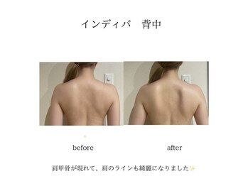 グランツ 小山店/インディバ背中