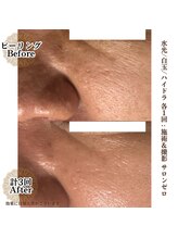 サロンゼロ 池上店(Salon ZERO)/ハイドラスノー/白玉美肌/水光肌