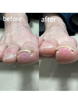 北区天神橋巻き爪センター/巻き爪