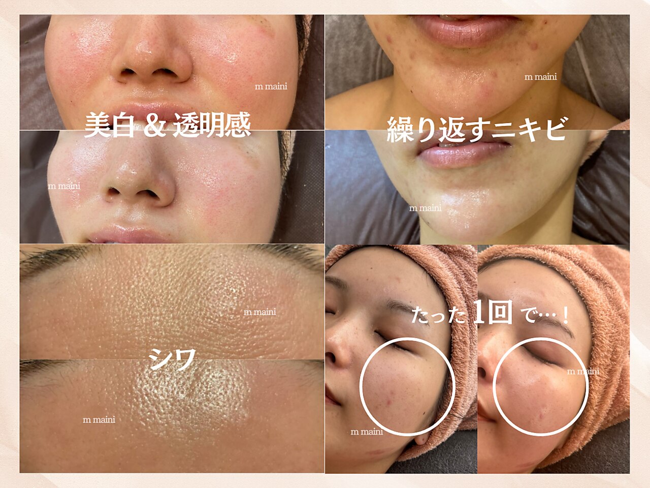 美ラボ様限定剥離ありハーブピーリング50回分 スマイルビューティラボ