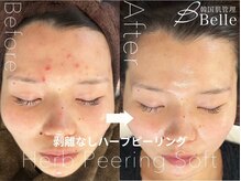 ベル 松本(Belle)/ハーブピーリング/毛穴/毛穴ケア